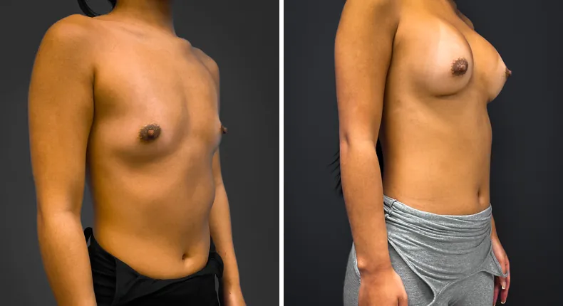 Before and after breast augmentation: patient's breasts from the right side