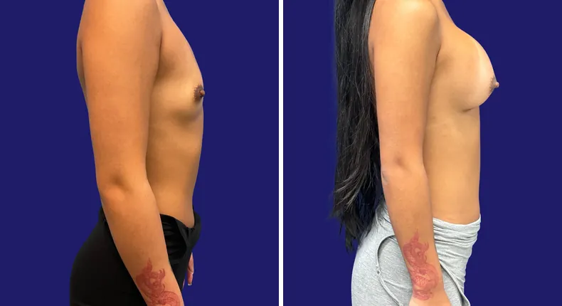 Before and after breast augmentation: woman's breasts