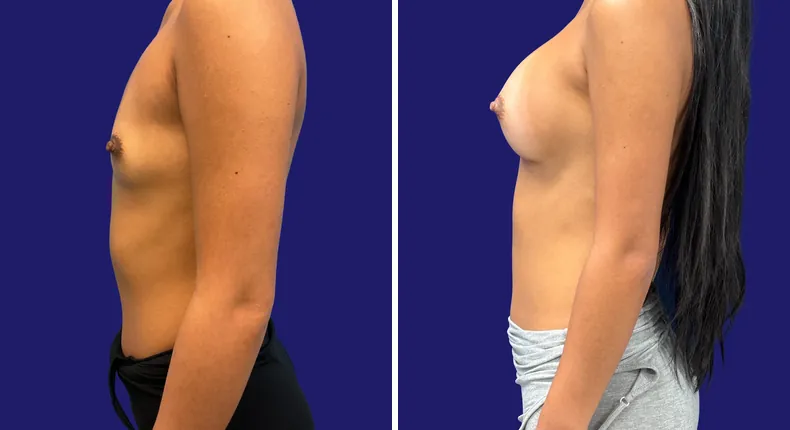 Before and after breast augmentation: woman's breasts