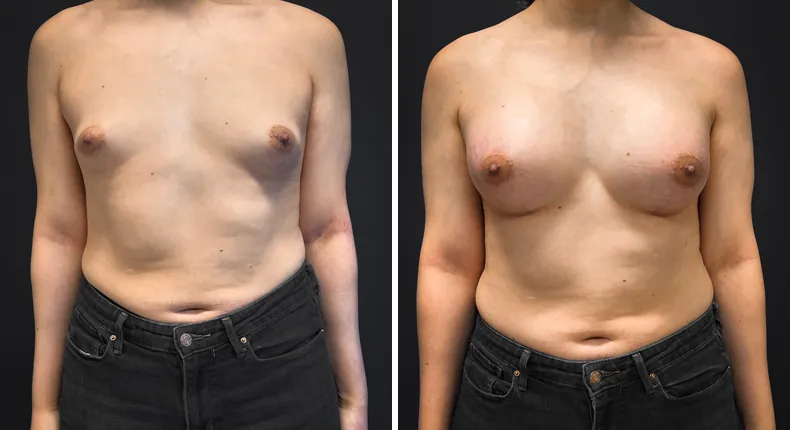 Before and after breast augmentation: patient's breasts from the front