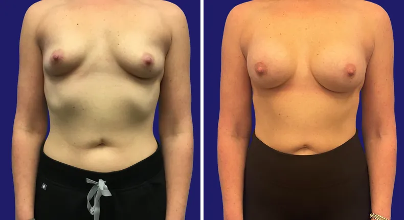 Before and after breast augmentation: woman's breasts from the front