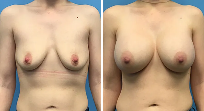 Before and after breast augmentation: patient's breasts from the front