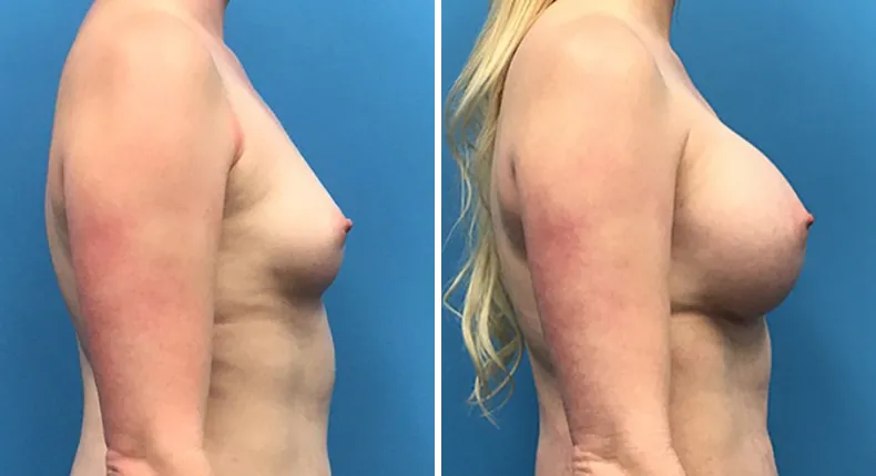 Before and after breast augmentation: woman's breasts from the right side