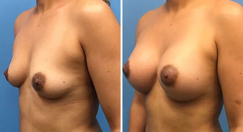 Before and after breast augmentation: woman's breasts at a left angle