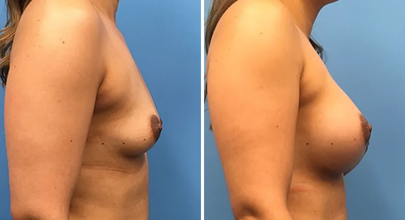Before and after breast augmentation: woman's breasts from the right side