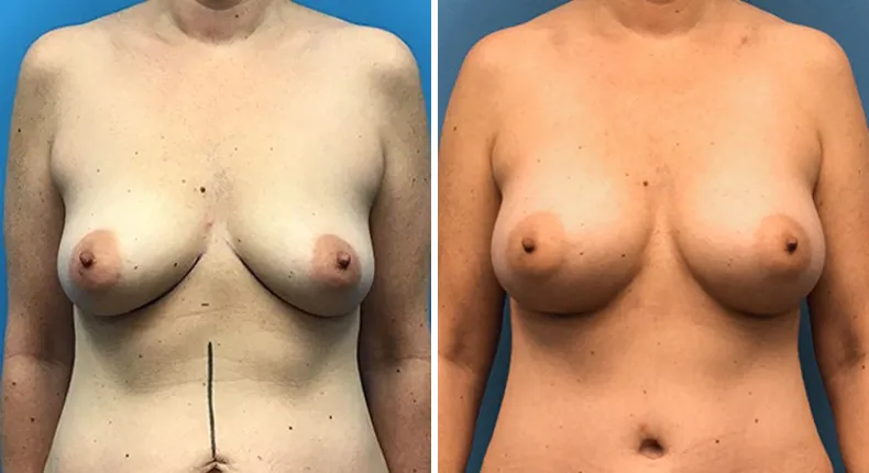 Before and after breast augmentation: woman's breasts from the front