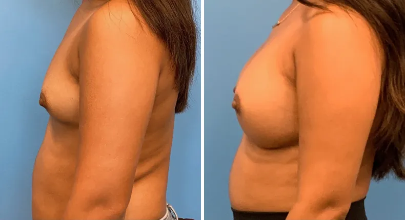 Before and after breast augmentation: patient's breasts from the left side
