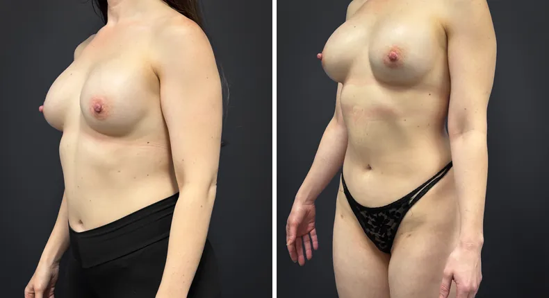 Before and after breast augmentation: woman's breasts at a left angle