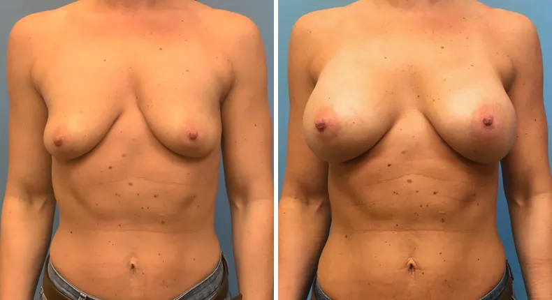 Before and after breast augmentation: woman's breasts from the front