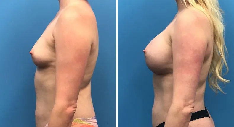 Before and after breast augmentation: patient's breasts from the left side