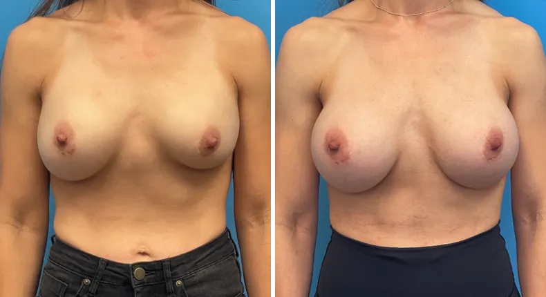 Before and after breast augmentation: woman's breasts from the front