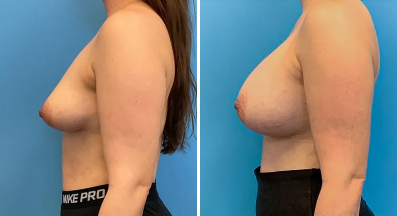 Before and after breast augmentation: patient's breasts from the left side