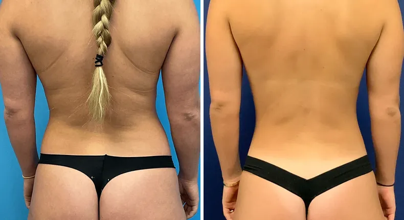 Before and after breast augmentation: patient's breasts from the back
