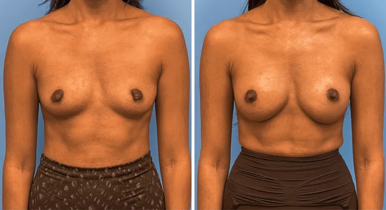 Before and after breast augmentation: woman's breasts from the front