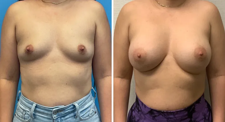 Before and after breast augmentation: woman's breasts from the front
