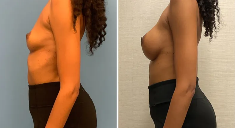 Before and after breast augmentation: woman's breasts from the left side