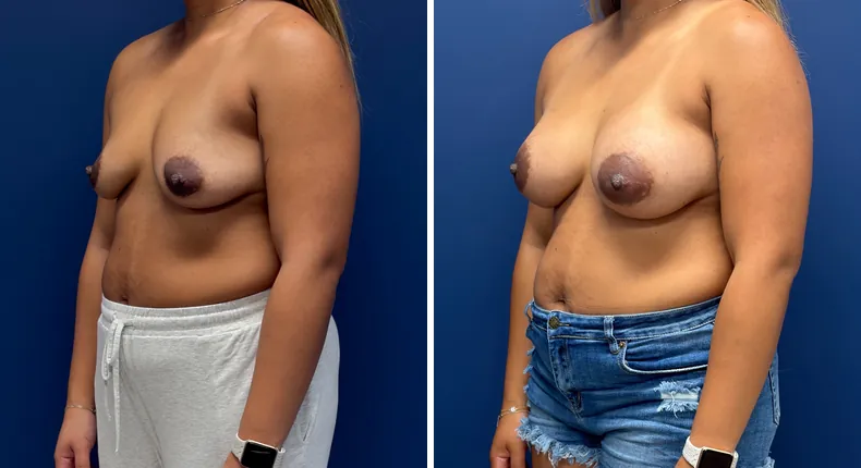 Before and after breast augmentation: woman's breasts
