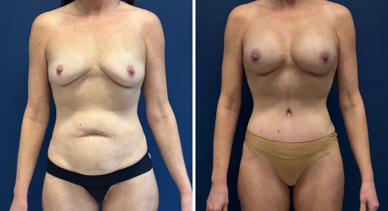Before and after breast augmentation: patient's breasts, with tummy tuck