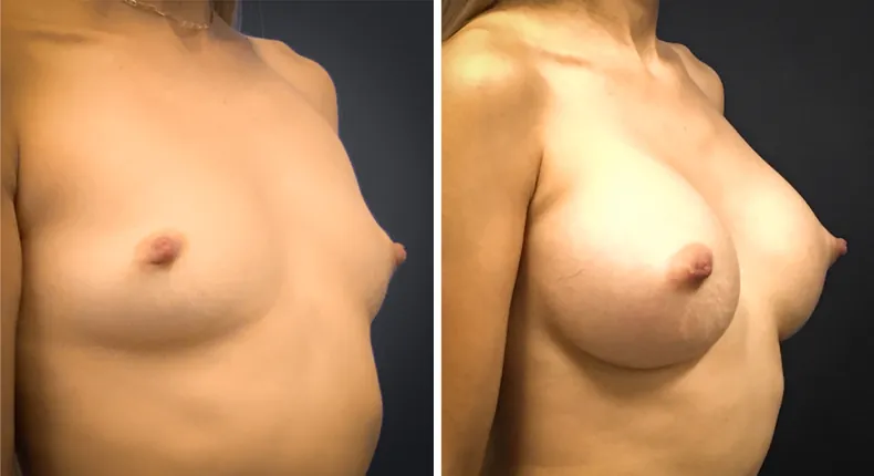 Before and after breast augmentation: woman's breasts at a right angle