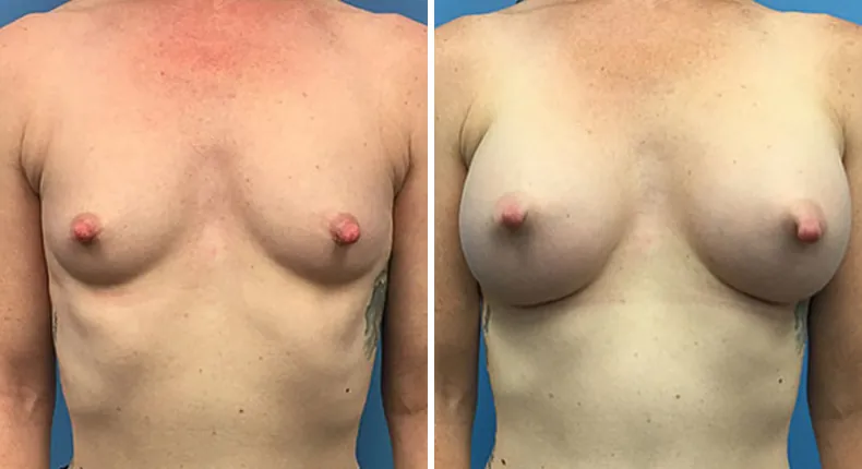 Before and after breast augmentation: woman's breasts from the front