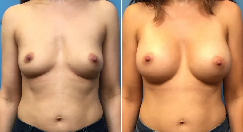 Before and after breast augmentation: patient's breasts from the front