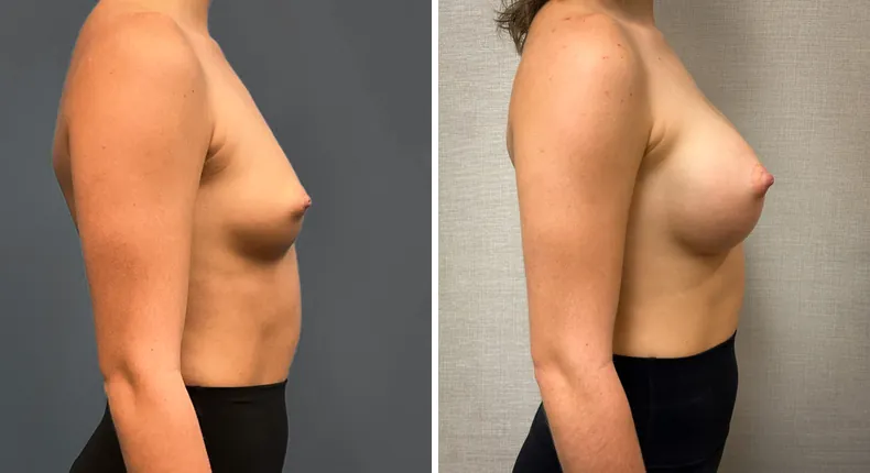 Before and after breast augmentation: woman's breasts from the right side