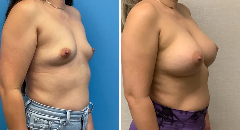 Before and after breast augmentation: woman's breasts at a right angle