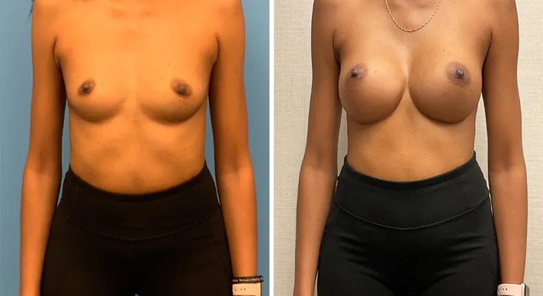 Before and after breast augmentation: woman's breasts from the front