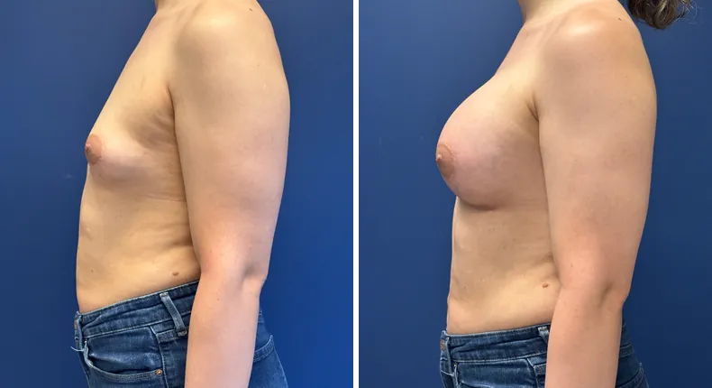 Before and after breast augmentation: woman's breasts from the left side