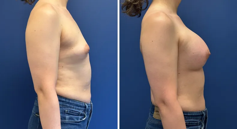 Before and after breast augmentation: woman's breasts from the right side