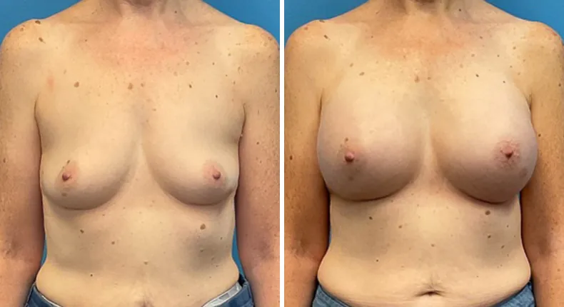 Before and after breast augmentation: woman's breasts from the front