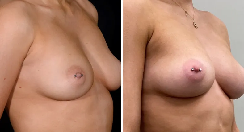 Before and after breast augmentation: patient's breasts at a right angle