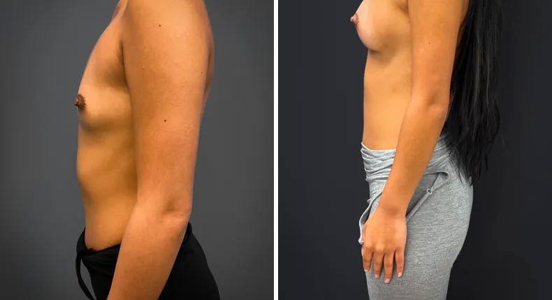 Before and after breast augmentation: patient's breasts from the left side
