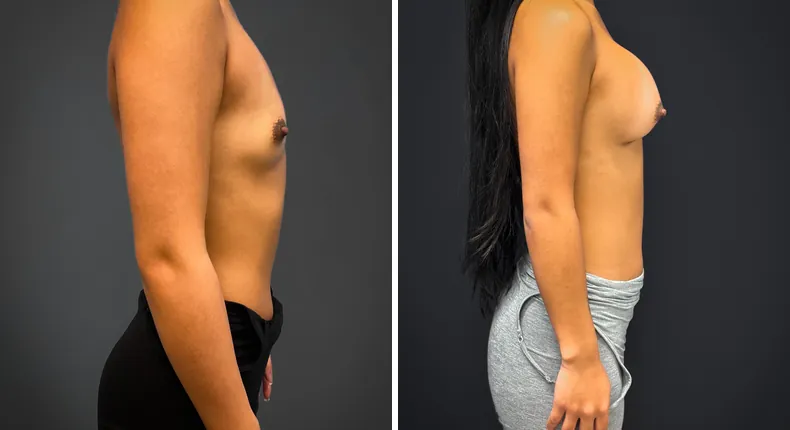 Before and after breast augmentation: patient's breasts from the right side