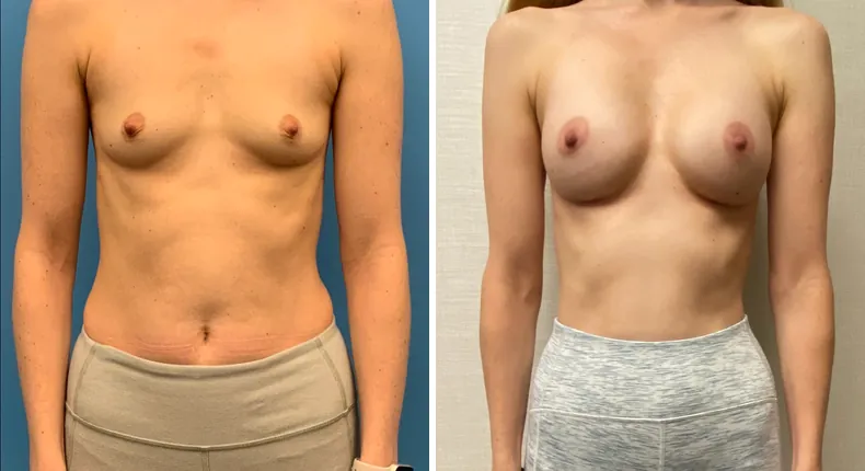 Before and after breast augmentation: woman's breasts from the front