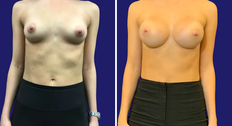 Before and after breast augmentation: woman's breasts
