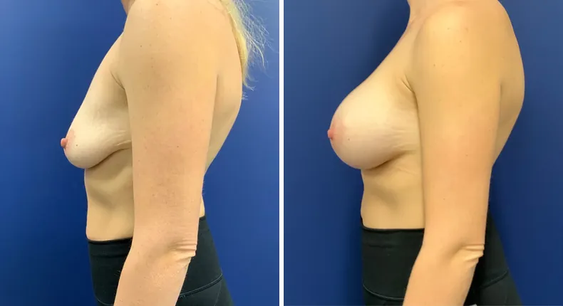Before and after breast augmentation: woman's breasts from the left side