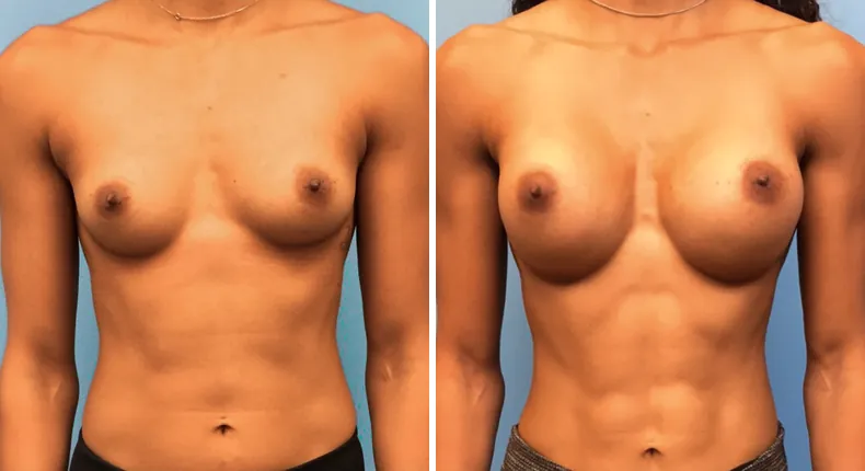 Before and after breast augmentation: patient's breasts from the front