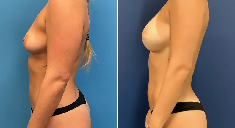 Before and after breast augmentation: patient's breasts in left profile
