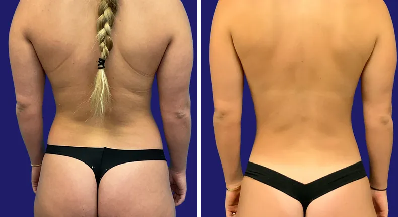 Before and after breast augmentation: woman's breasts, with liposuction and mommy makeover