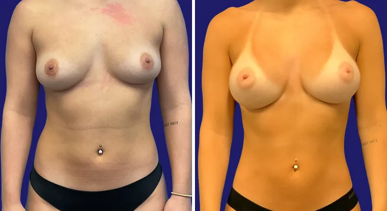 Before and after breast augmentation: woman's breasts, with liposuction and mommy makeover
