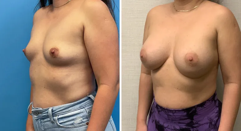 Before and after breast augmentation: woman's breasts at a left angle