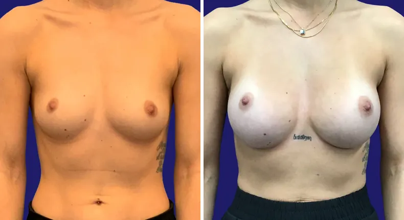 Before and after breast augmentation: woman's breasts from the front