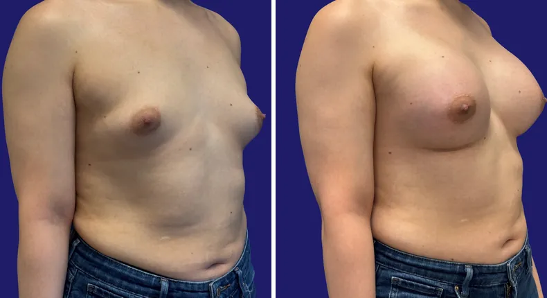 Before and after breast augmentation: woman's breasts
