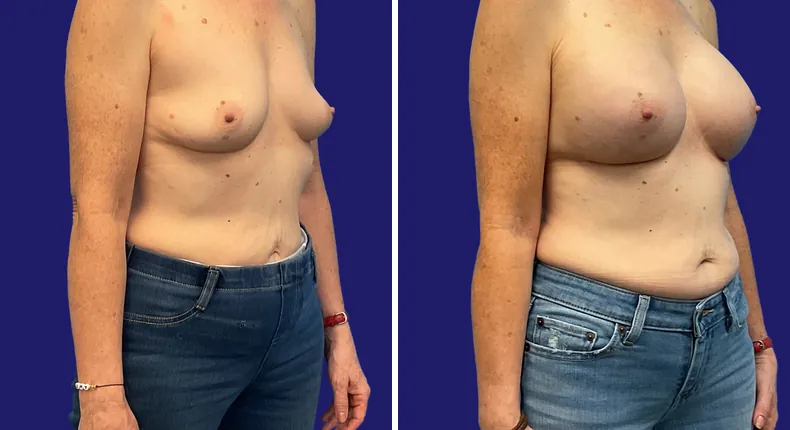 Before and after breast augmentation: woman's breasts