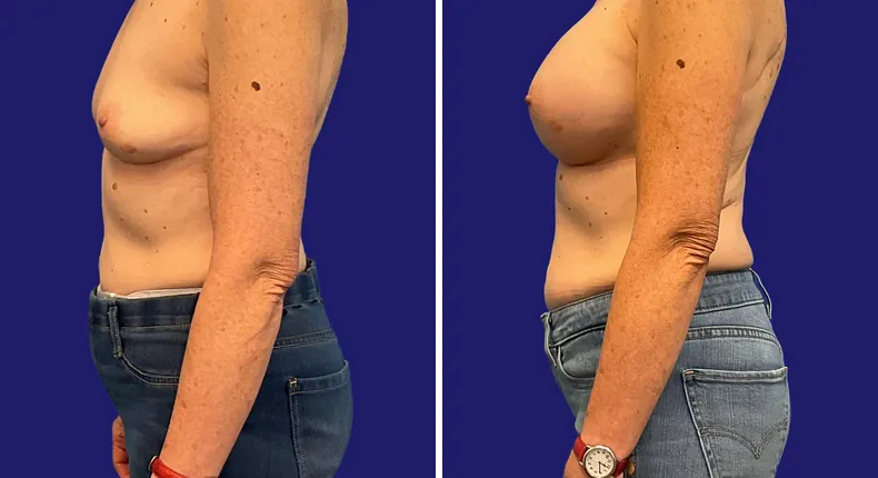 Before and after breast augmentation: woman's breasts