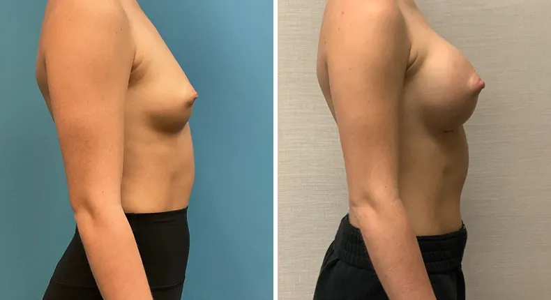 Before and after breast augmentation: patient's breasts in right profile