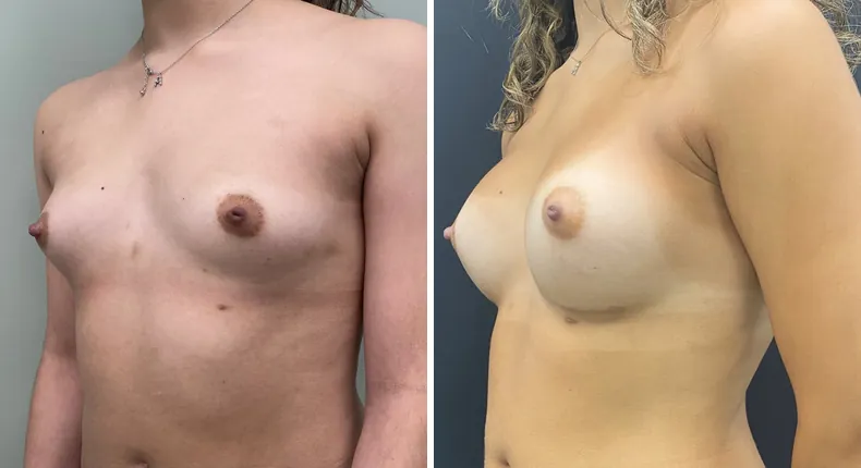 Before and after breast augmentation: woman's breasts at a left angle