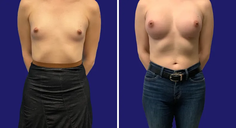 Before and after breast augmentation: woman's breasts from the front