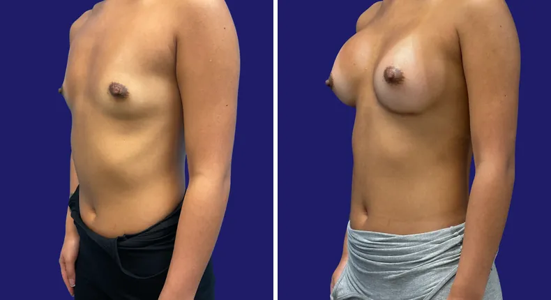Before and after breast augmentation: woman's breasts